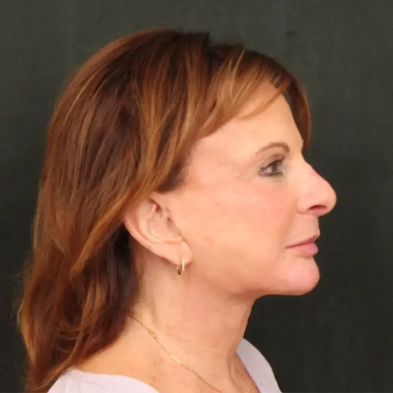 Dr. William Harris - Harris Facial Plastic Surgery & Aesthetics facelift after — Beverly Hills, CA