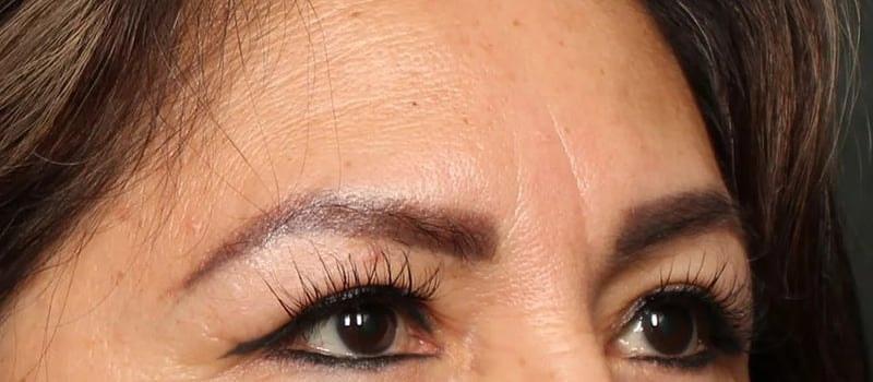 Dr. William Harris - Harris Facial Plastic Surgery & Aesthetics eyelid lift after — Beverly Hills, CA