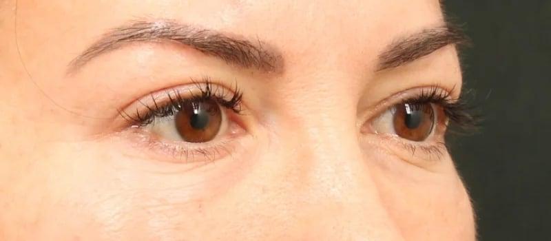 Dr. William Harris - Harris Facial Plastic Surgery & Aesthetics blepharoplasty result — Beverly Hills, CA