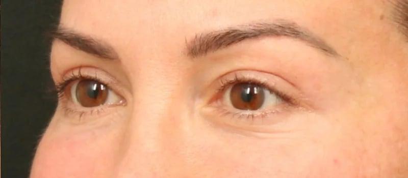 Dr. William Harris - Harris Facial Plastic Surgery & Aesthetics blepharoplasty result — Beverly Hills, CA