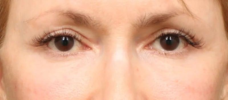 Dr. William Harris - Harris Facial Plastic Surgery & Aesthetics blepharoplasty result — Beverly Hills, CA