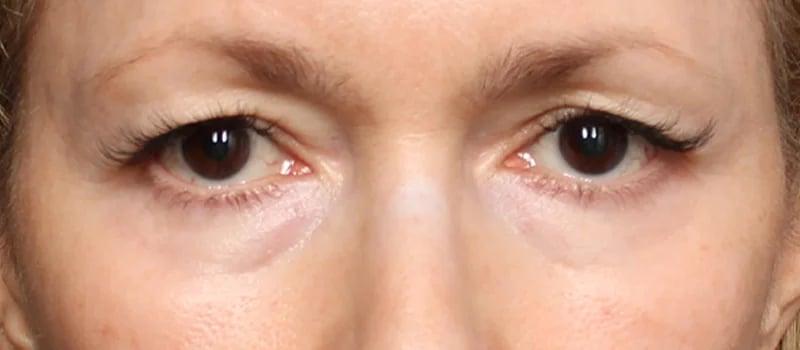 Dr. William Harris - Harris Facial Plastic Surgery & Aesthetics blepharoplasty result — Beverly Hills, CA