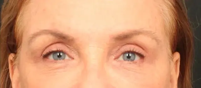 Brow Lift after at Dr. William Harris - Harris Facial Plastic Surgery & Aesthetics in Beverly Hills, CA