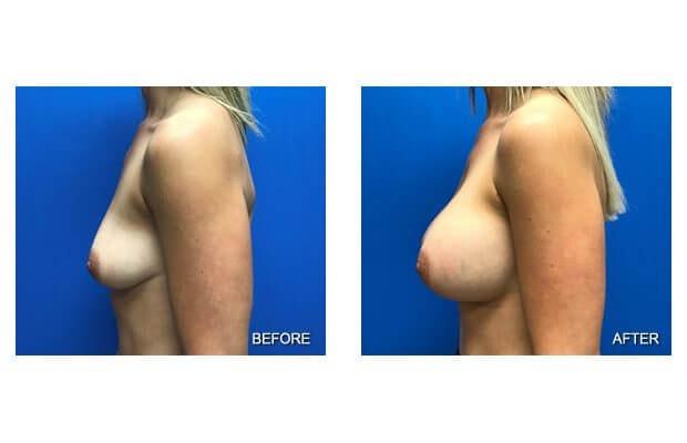 Lohith Bose, MD breast augmentation result — Tampa, FL