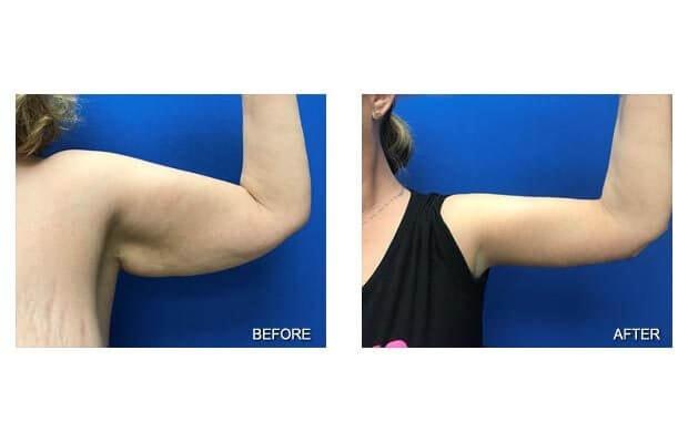 Arm Lift result at Lohith Bose, MD in Tampa, FL