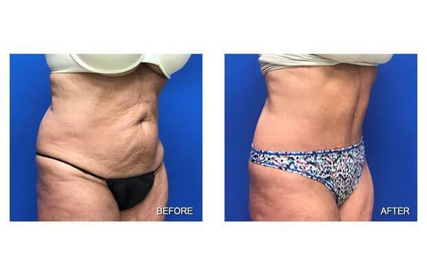 Lohith Bose, MD tummy tuck result — Tampa, FL