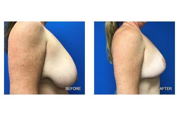 Breast Reduction result at Lohith Bose, MD in Tampa, FL