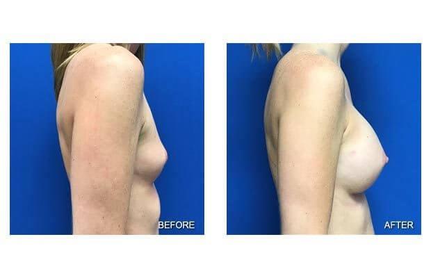 Fat Transfer Breast Augmentation result at Lohith Bose, MD in Tampa, FL