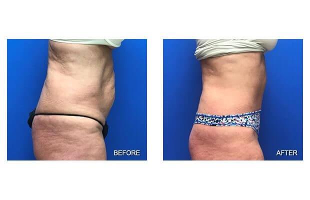 Lohith Bose, MD tummy tuck result — Tampa, FL