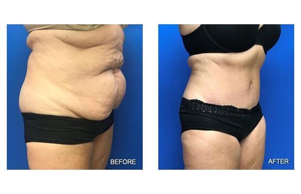Lohith Bose, MD tummy tuck result — Tampa, FL