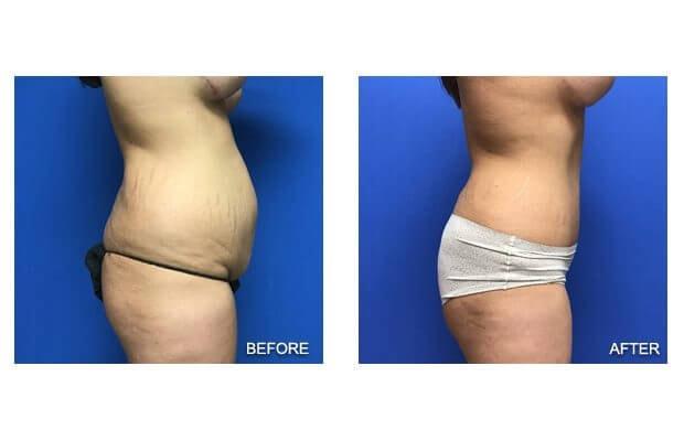 Lohith Bose, MD tummy tuck result — Tampa, FL