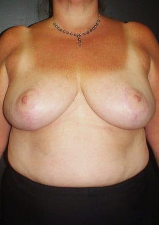 Park Avenue Plastic Surgery (Douglas Monasebian, MD) breast reduction after — New York, NY