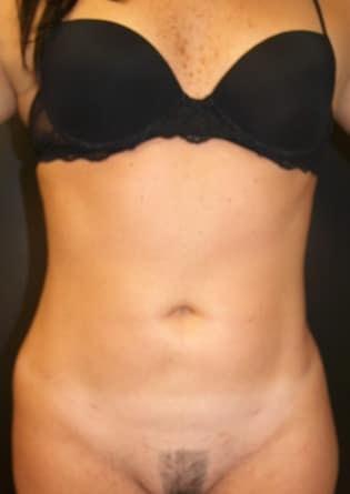 Park Avenue Plastic Surgery (Douglas Monasebian, MD) liposuction after — New York, NY