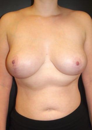 Park Avenue Plastic Surgery (Douglas Monasebian, MD) breast reduction after — New York, NY