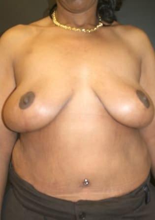 Park Avenue Plastic Surgery (Douglas Monasebian, MD) breast lift after — New York, NY