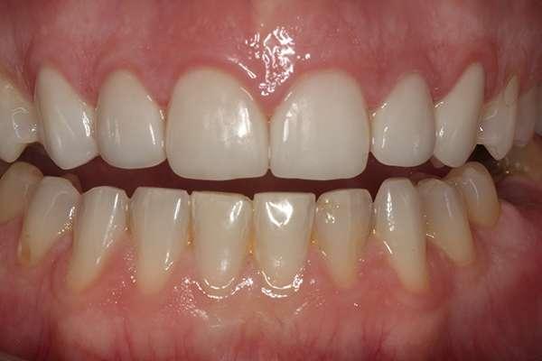 Highlands Family Dentistry smile makeover after — Dallas, TX