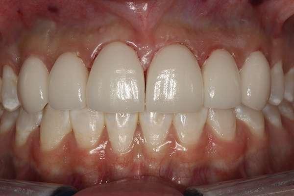 Highlands Family Dentistry smile makeover after — Dallas, TX