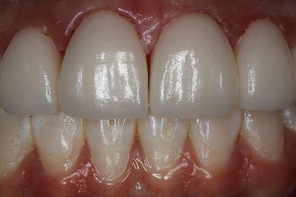 Highlands Family Dentistry smile makeover after — Dallas, TX