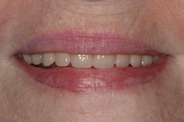 Highlands Family Dentistry smile makeover after — Dallas, TX