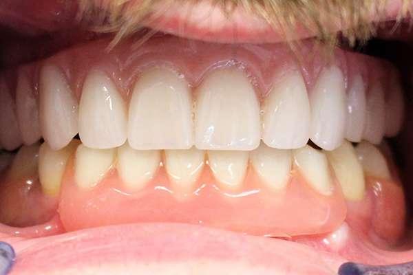 Highlands Family Dentistry smile makeover after — Dallas, TX