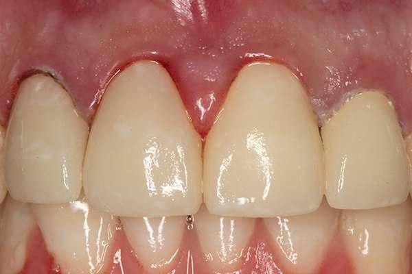 Highlands Family Dentistry smile makeover after — Dallas, TX
