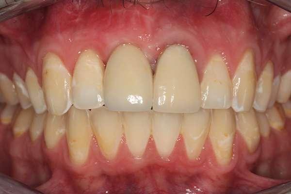 Highlands Family Dentistry smile makeover after — Dallas, TX