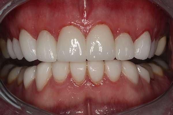 Highlands Family Dentistry smile makeover after — Dallas, TX
