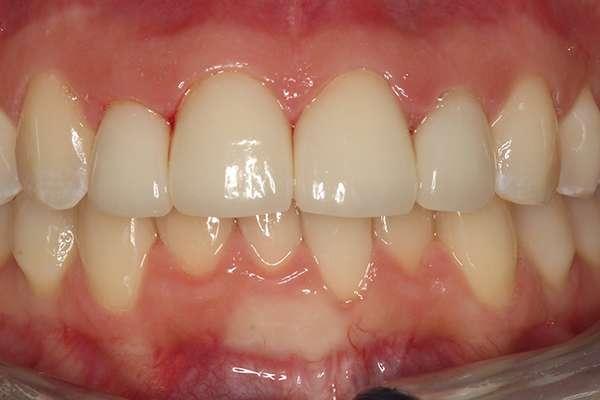 Highlands Family Dentistry smile makeover after — Dallas, TX