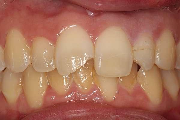 Smile Makeover before at Highlands Family Dentistry in Dallas, TX