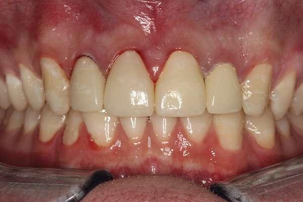 Highlands Family Dentistry smile makeover after — Dallas, TX