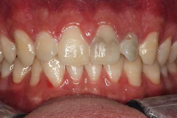 Smile Makeover before at Highlands Family Dentistry in Dallas, TX