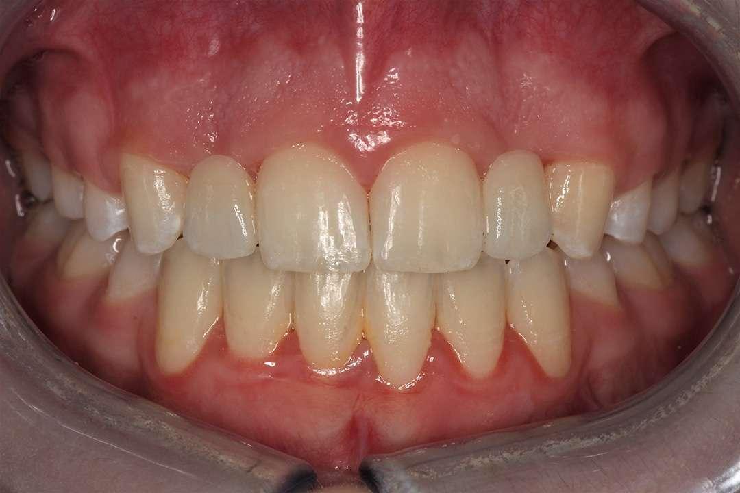 Highlands Family Dentistry smile makeover after — Dallas, TX