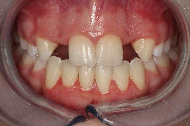 Smile Makeover before at Highlands Family Dentistry in Dallas, TX
