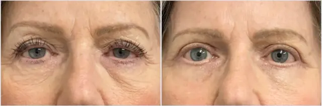 Chemical Peel result at Oculoplastic & Orbital Consultants in Palm Beach Gardens, FL