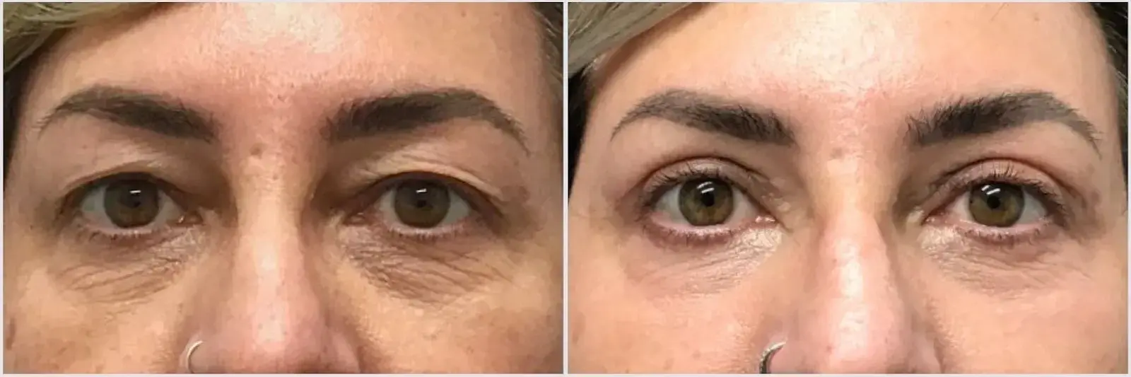Oculoplastic & Orbital Consultants blepharoplasty result — Palm Beach Gardens, FL