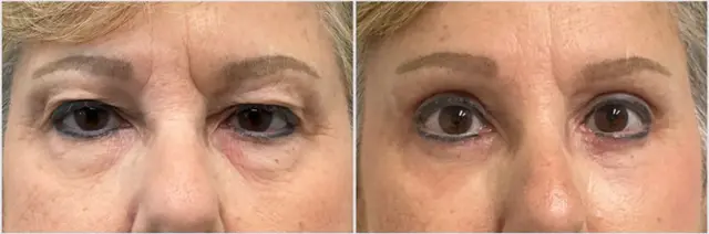 Brow Lift result at Oculoplastic & Orbital Consultants in Palm Beach Gardens, FL