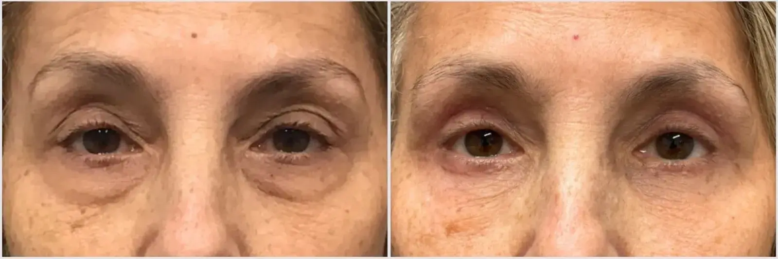 Oculoplastic & Orbital Consultants blepharoplasty result — Palm Beach Gardens, FL