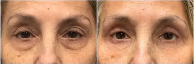 Blepharoplasty result at Oculoplastic & Orbital Consultants in Palm Beach Gardens, FL