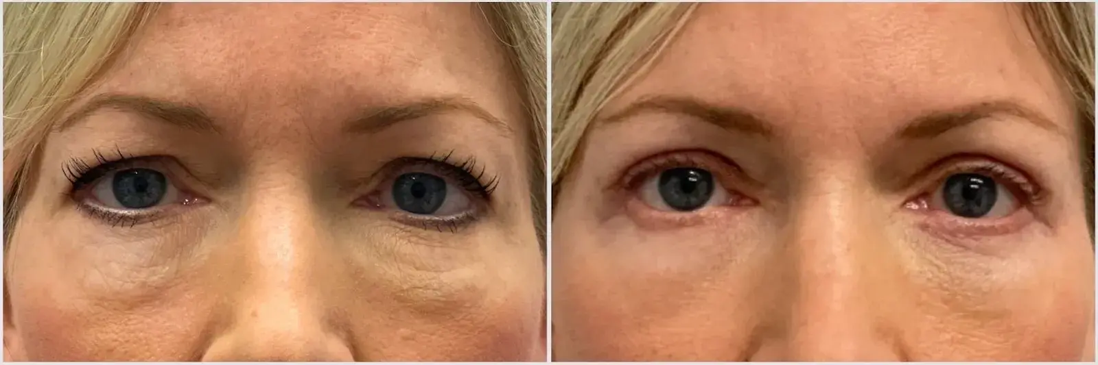 Oculoplastic & Orbital Consultants blepharoplasty result — Palm Beach Gardens, FL