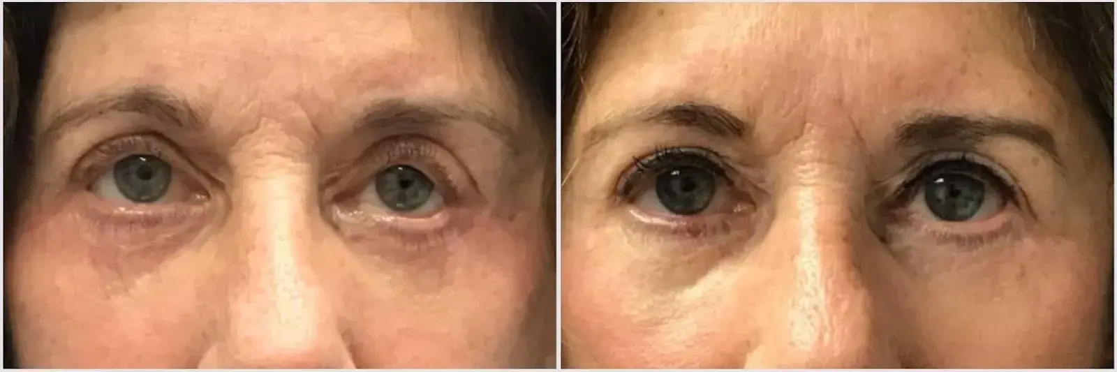 Oculoplastic & Orbital Consultants blepharoplasty result — Palm Beach Gardens, FL