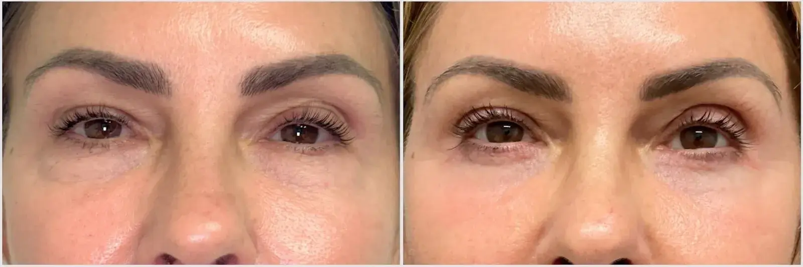 Oculoplastic & Orbital Consultants chemical peel result — Palm Beach Gardens, FL