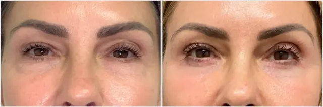 Chemical Peel result at Oculoplastic & Orbital Consultants in Palm Beach Gardens, FL
