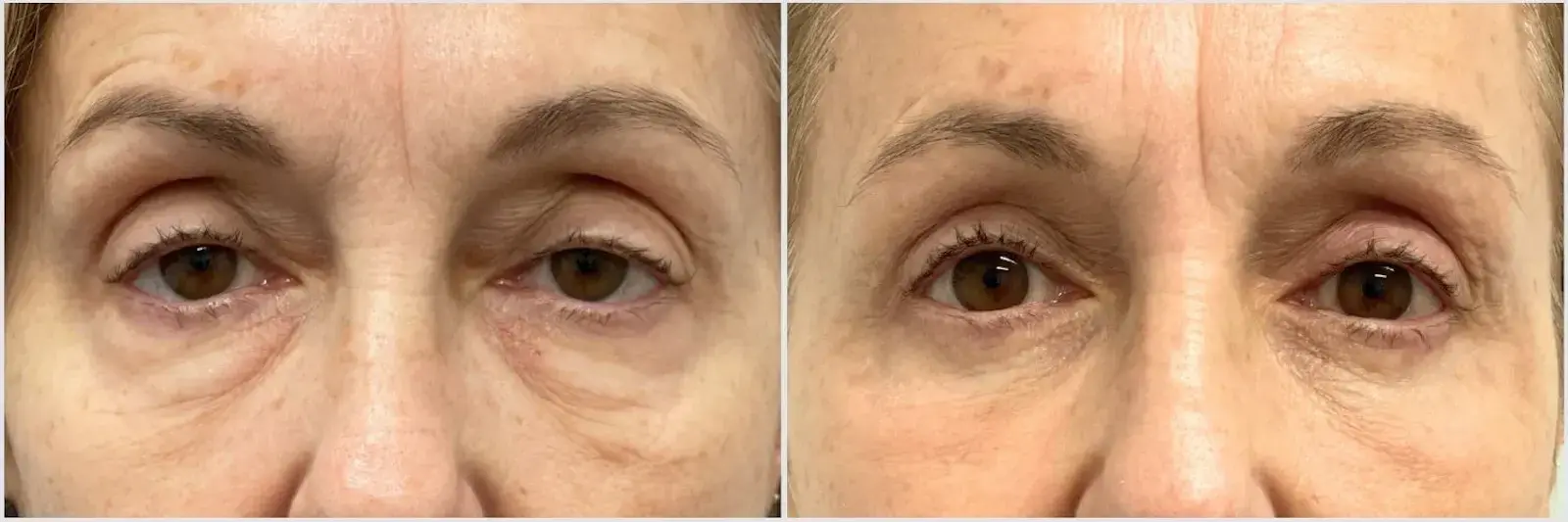 Oculoplastic & Orbital Consultants chemical peel result — Palm Beach Gardens, FL
