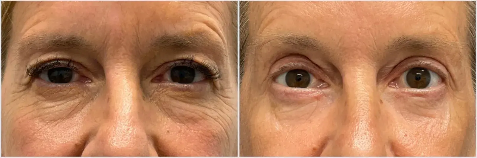 Oculoplastic & Orbital Consultants blepharoplasty result — Palm Beach Gardens, FL