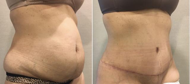 Tummy Tuck result at Dr. Dana K. Khuthaila in New York, NY