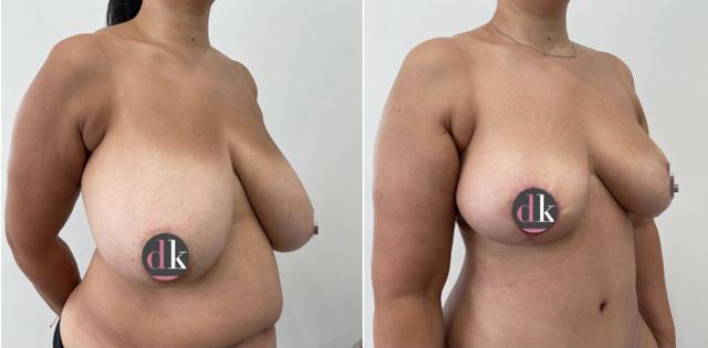 Mommy Makeover result at Dr. Dana K. Khuthaila in New York, NY