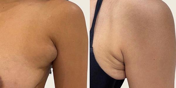 Liposuction result at Dr. Dana K. Khuthaila in New York, NY