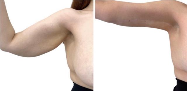Arm Lift result at Dr. Dana K. Khuthaila in New York, NY