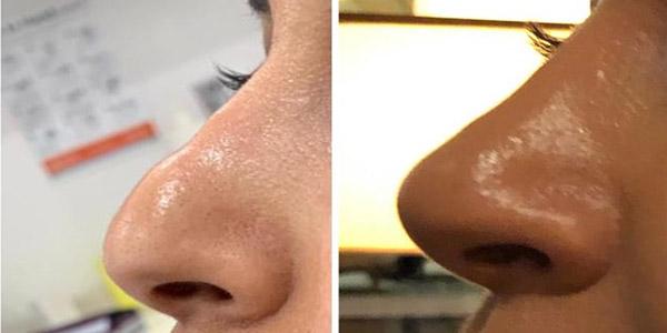 Rhinoplasty result at Dr. Dana K. Khuthaila in New York, NY