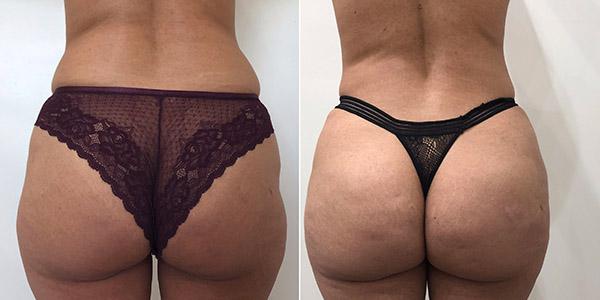 Brazilian Butt Lift result at Dr. Dana K. Khuthaila in New York, NY